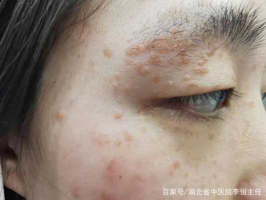 孕期脸上长疣(孕期脸上长疣怎么办) 第2张 孕期脸上长疣(孕期脸上长疣怎么办) 第2张