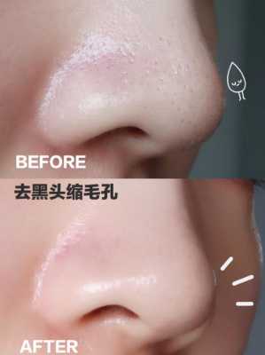 孕期如何去黑头(孕期如何去黑头) 第3张 孕期如何去黑头(孕期如何去黑头) 第3张