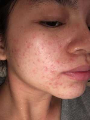 孕期脸上长痘痘(怀孕起痘痘) 第2张 孕期脸上长痘痘(怀孕起痘痘) 第2张