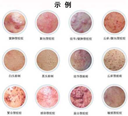 孕妇乳头出血是怎能么回事,孕期乳头出血原因有哪些 第1张 孕妇乳头出血是怎能么回事,孕期乳头出血原因有哪些 第1张