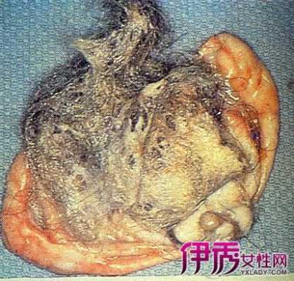 孕期畸胎瘤(孕期畸胎瘤) 第2张 孕期畸胎瘤(孕期畸胎瘤) 第2张