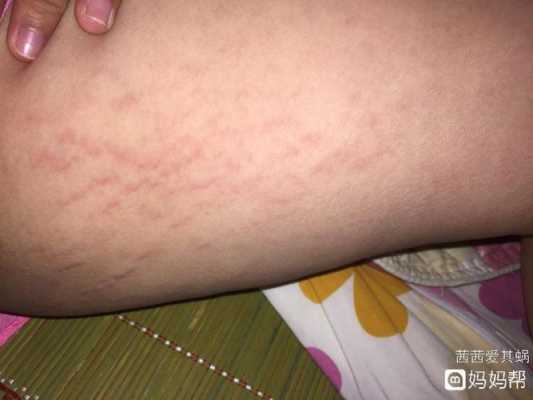 为什么孕妇腿上会长妊娠纹,孕期大腿有纹路 第1张 为什么孕妇腿上会长妊娠纹,孕期大腿有纹路 第1张