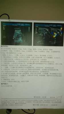 胎儿右心室强光斑原因(左室强光点是什么原因) 第2张 胎儿右心室强光斑原因(左室强光点是什么原因) 第2张