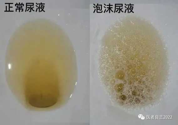 孕妇尿黄有泡沫是怎么回事,孕期尿液有泡沫是怎么回事 第1张 孕妇尿黄有泡沫是怎么回事,孕期尿液有泡沫是怎么回事 第1张