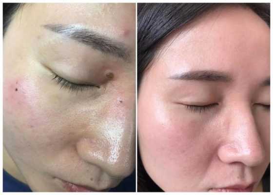 孕期能去痣吗(孕期能去痣吗有影响吗) 第2张 孕期能去痣吗(孕期能去痣吗有影响吗) 第2张
