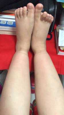 腿上有袜子勒出的印是什么回事,孕妇肚子勒印影响胎儿吗 第3张 腿上有袜子勒出的印是什么回事,孕妇肚子勒印影响胎儿吗 第3张