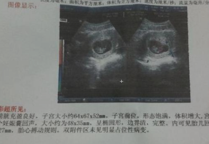 孕5个周胎儿图(孕七周B超显示五周,是不是代表胎儿发育不好) 第2张 孕5个周胎儿图(孕七周B超显示五周,是不是代表胎儿发育不好) 第2张