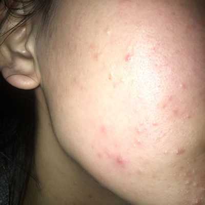 怀孕脸上长痘痘是什么原因,孕期脸上长粉刺是怎么回事 第1张 怀孕脸上长痘痘是什么原因,孕期脸上长粉刺是怎么回事 第1张