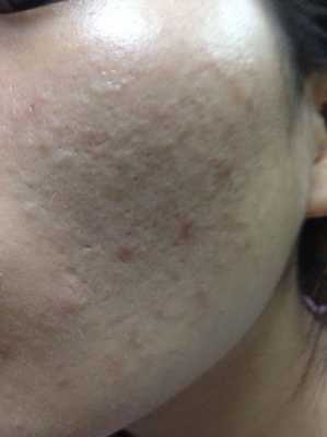 怀孕脸上长痘痘是什么原因,孕期脸上长粉刺是怎么回事 第3张 怀孕脸上长痘痘是什么原因,孕期脸上长粉刺是怎么回事 第3张