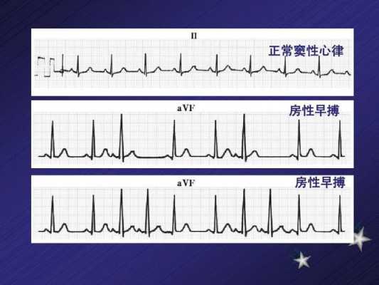 孕期心电图窦性心律(正常窦性心律什么意思) 第3张 孕期心电图窦性心律(正常窦性心律什么意思) 第3张