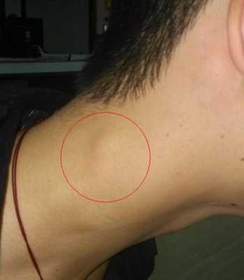 脖子囊肿是什么原因,胎儿颈部有囊肿严重吗怎么办 第2张 脖子囊肿是什么原因,胎儿颈部有囊肿严重吗怎么办 第2张