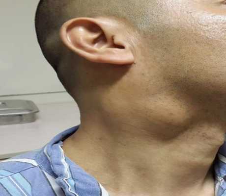 脖子囊肿是什么原因,胎儿颈部有囊肿严重吗怎么办 第1张 脖子囊肿是什么原因,胎儿颈部有囊肿严重吗怎么办 第1张