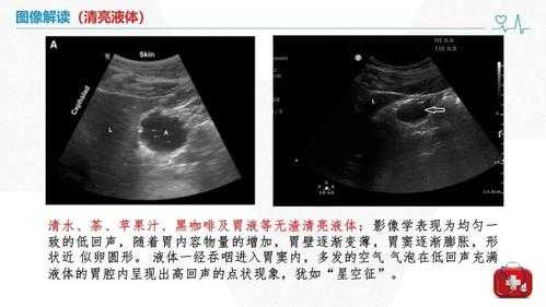 正常胎儿胃泡位于哪儿（正常胎儿胃泡位于哪儿）  第1张