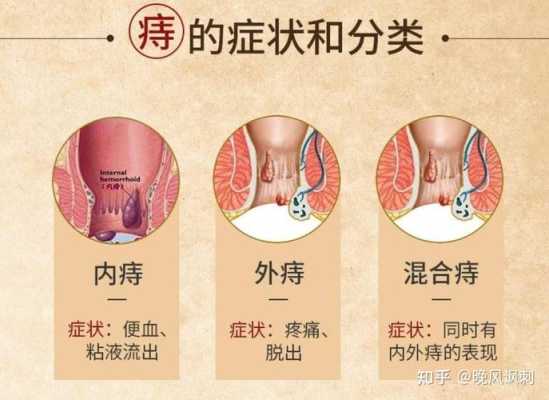 备孕期间痔疮(备孕一定要割痔疮吗) 第1张 备孕期间痔疮(备孕一定要割痔疮吗) 第1张