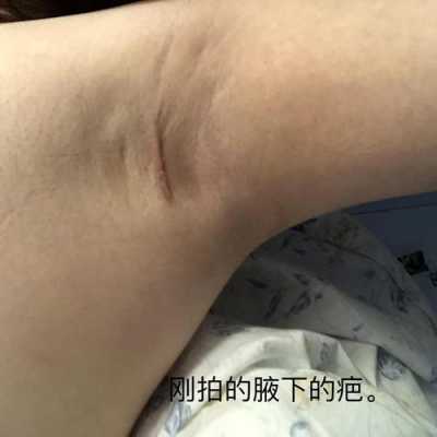 孕期长出副乳(孕期长出副乳生后会消失吗) 第1张 孕期长出副乳(孕期长出副乳生后会消失吗) 第1张