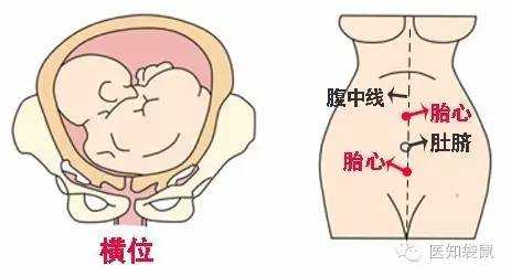 宝宝一岁一个月,走路高低肩严重,宫高低一定是胎儿小吗 第1张 宝宝一岁一个月,走路高低肩严重,宫高低一定是胎儿小吗 第1张