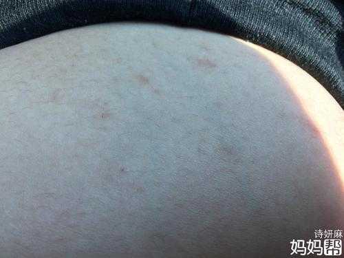 孕期乳房结痂图片(孕期乳房结痂图片) 第1张 孕期乳房结痂图片(孕期乳房结痂图片) 第1张