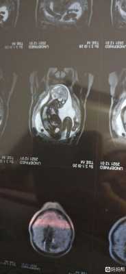胎儿磁共振能查出什么(核磁共振有辐射吗?孕妇可以做吗) 第1张 胎儿磁共振能查出什么(核磁共振有辐射吗?孕妇可以做吗) 第1张