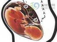 胎儿在肚子里溶血症状(胎儿在肚子里溶血症状) 第2张 胎儿在肚子里溶血症状(胎儿在肚子里溶血症状) 第2张