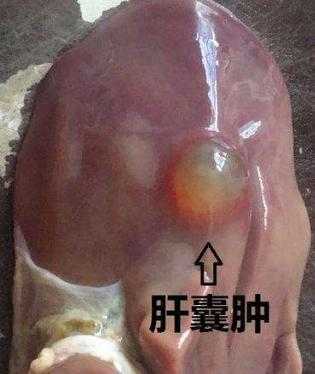 胎儿肝囊肿会消失吗(肝囊肿会不会自己消掉) 第1张 胎儿肝囊肿会消失吗(肝囊肿会不会自己消掉) 第1张