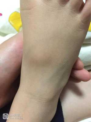 婴儿脚背骨头凸起是怎么了,胎儿骨骼发育不良原因有哪些 第1张 婴儿脚背骨头凸起是怎么了,胎儿骨骼发育不良原因有哪些 第1张