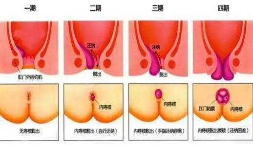 孕期肛门脱垂(肛门脱垂如何治疗) 第2张 孕期肛门脱垂(肛门脱垂如何治疗) 第2张