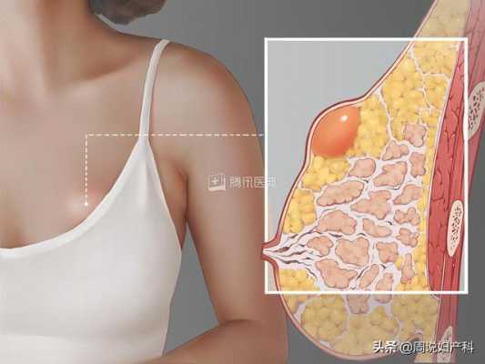 孕期胸部有硬块(孕期乳房有硬块不疼怎么办) 第1张 孕期胸部有硬块(孕期乳房有硬块不疼怎么办) 第1张