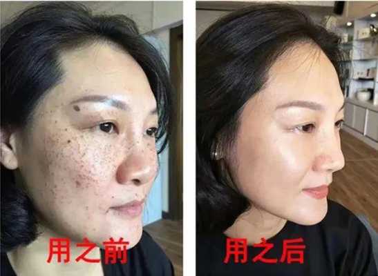 孕期能去斑吗(孕妇可以用维生素e擦脸祛斑吗) 第2张 孕期能去斑吗(孕妇可以用维生素e擦脸祛斑吗) 第2张