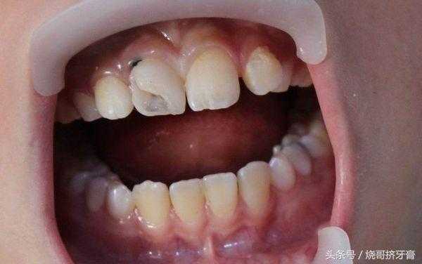孕期能看牙医吗(孕妇牙洞疼烂到神经了怎么办) 第1张 孕期能看牙医吗(孕妇牙洞疼烂到神经了怎么办) 第1张