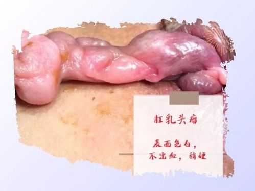 肛门息肉的症状有哪些,孕期息肉出血怎么办 第1张 肛门息肉的症状有哪些,孕期息肉出血怎么办 第1张