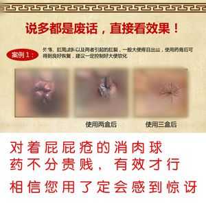 肛门息肉的症状有哪些,孕期息肉出血怎么办 第2张 肛门息肉的症状有哪些,孕期息肉出血怎么办 第2张