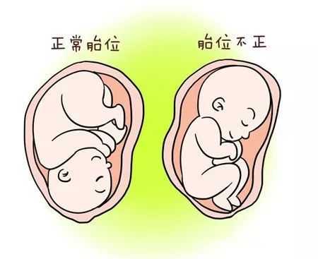 胎位不正是胎儿畸形吗(胎位不正是胎儿畸形吗) 第1张 胎位不正是胎儿畸形吗(胎位不正是胎儿畸形吗) 第1张