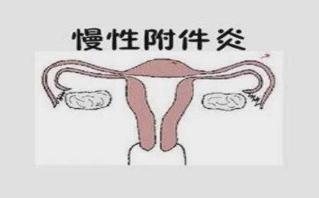 附件炎可以怀孕吗,孕期附件炎疼痛怎么办 第2张 附件炎可以怀孕吗,孕期附件炎疼痛怎么办 第2张