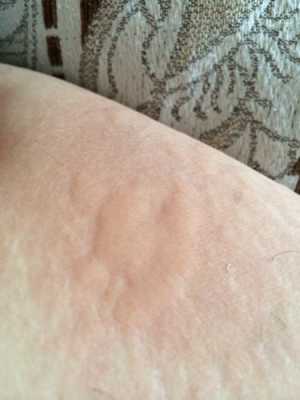 孕晚期大腿内侧长湿疹的很痒怎么治疗,孕期大腿内侧痒痒越抓越痒有小红疙瘩 第1张 孕晚期大腿内侧长湿疹的很痒怎么治疗,孕期大腿内侧痒痒越抓越痒有小红疙瘩 第1张