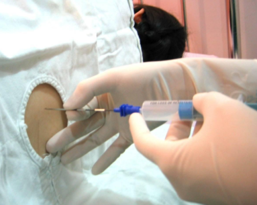 剖腹产全麻对胎儿智力(剖腹产脊椎打麻药疼吗) 第1张 剖腹产全麻对胎儿智力(剖腹产脊椎打麻药疼吗) 第1张