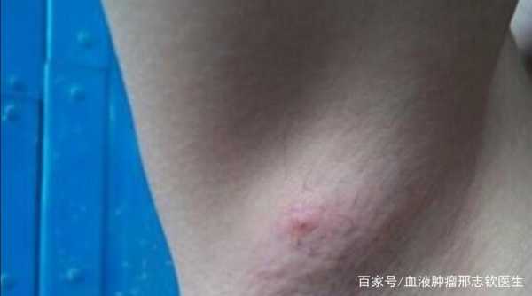 孕期淋巴长痘(怀孕后腋窝下有肉疙瘩是怎么回事) 第2张 孕期淋巴长痘(怀孕后腋窝下有肉疙瘩是怎么回事) 第2张