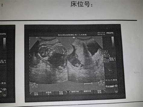 胎儿没胎心有什么征兆(胎儿没胎心有什么征兆吗) 第1张 胎儿没胎心有什么征兆(胎儿没胎心有什么征兆吗) 第1张