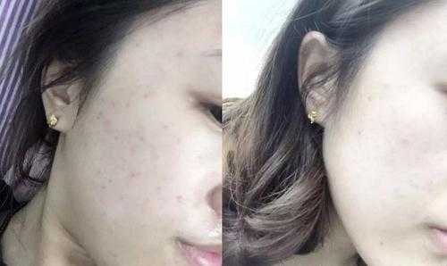 孕期身上长痘（孕妇长痘适合用什么面霜）  第2张