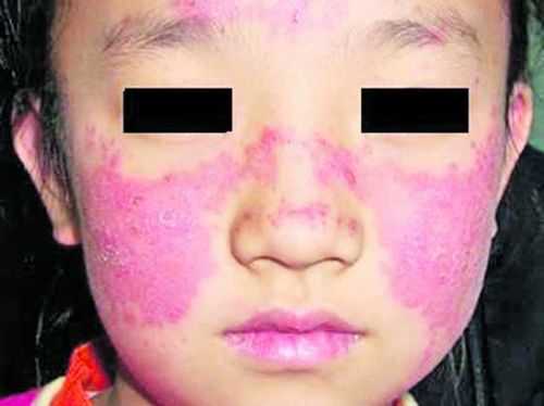 得了红斑狼疮怀孕了怎么办,孕期红斑狼疮是什么症状 第2张 得了红斑狼疮怀孕了怎么办,孕期红斑狼疮是什么症状 第2张