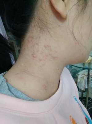 孕期不长痘痘(以前不长痘痘,为什么怀孕后长痘痘呢) 第3张 孕期不长痘痘(以前不长痘痘,为什么怀孕后长痘痘呢) 第3张