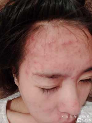 孕期不长痘痘(以前不长痘痘,为什么怀孕后长痘痘呢) 第1张 孕期不长痘痘(以前不长痘痘,为什么怀孕后长痘痘呢) 第1张