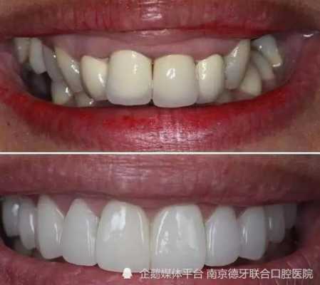 烤瓷牙都有哪些种,孕期烤瓷牙掉了可以粘么 第3张 烤瓷牙都有哪些种,孕期烤瓷牙掉了可以粘么 第3张