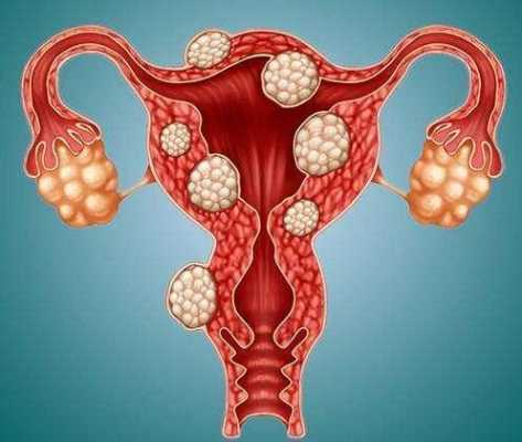 孕期查出子宫肌瘤(孕期查出子宫肌瘤要紧吗) 第2张 孕期查出子宫肌瘤(孕期查出子宫肌瘤要紧吗) 第2张