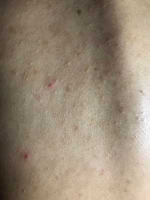 怎么去掉胸前和背后的痘痘和痘印,孕期胸口长痘痘怎么办 第2张 怎么去掉胸前和背后的痘痘和痘印,孕期胸口长痘痘怎么办 第2张