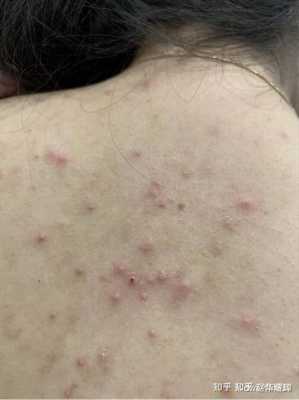 怎么去掉胸前和背后的痘痘和痘印,孕期胸口长痘痘怎么办 第1张 怎么去掉胸前和背后的痘痘和痘印,孕期胸口长痘痘怎么办 第1张