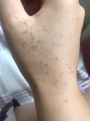 孕期手上长斑(脸上和手上都有斑点怎么办) 第2张 孕期手上长斑(脸上和手上都有斑点怎么办) 第2张