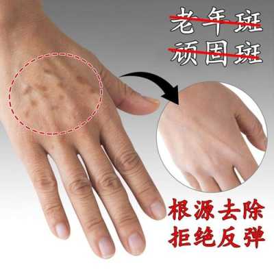 孕期手上长斑(脸上和手上都有斑点怎么办) 第3张 孕期手上长斑(脸上和手上都有斑点怎么办) 第3张