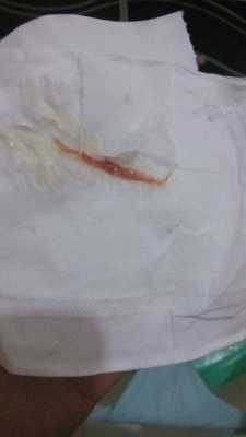 孕妇白带有血丝怎么办,孕中期分泌物有血丝但不出血 第1张 孕妇白带有血丝怎么办,孕中期分泌物有血丝但不出血 第1张