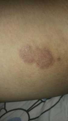 大腿内侧长有黑斑是怎么回事？还有私处发黑是怎么回事,孕期大腿内侧变黑什么原因  第1张