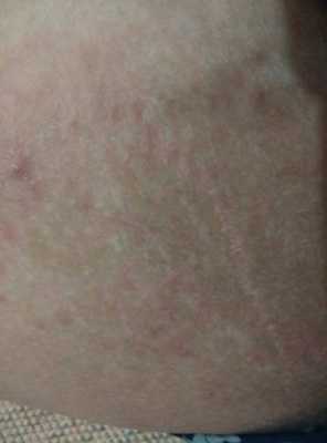 大腿内侧长有黑斑是怎么回事？还有私处发黑是怎么回事,孕期大腿内侧变黑什么原因  第2张